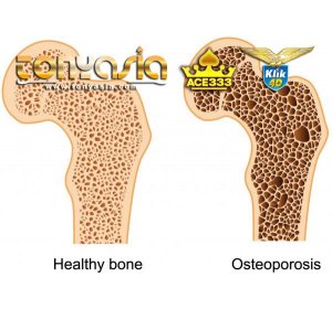 Wanita Rentan terkena osteoporosis | Judi Online Indonesia